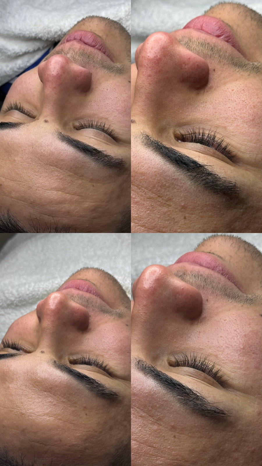 Limpieza facial, antes y después 🙌🏻
