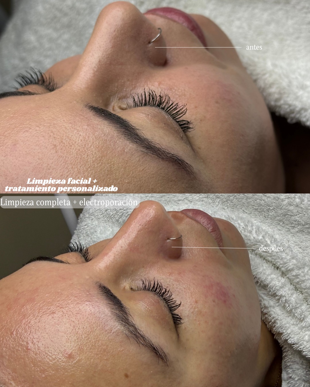 Antes y despues de tratamiento facial personalizado