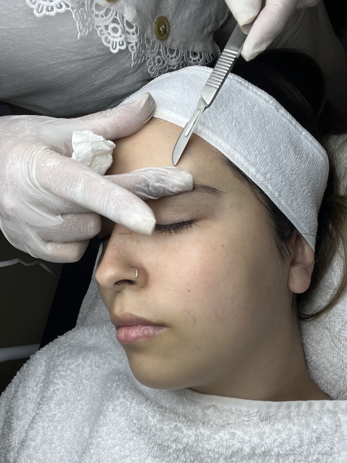 Dermaplaning