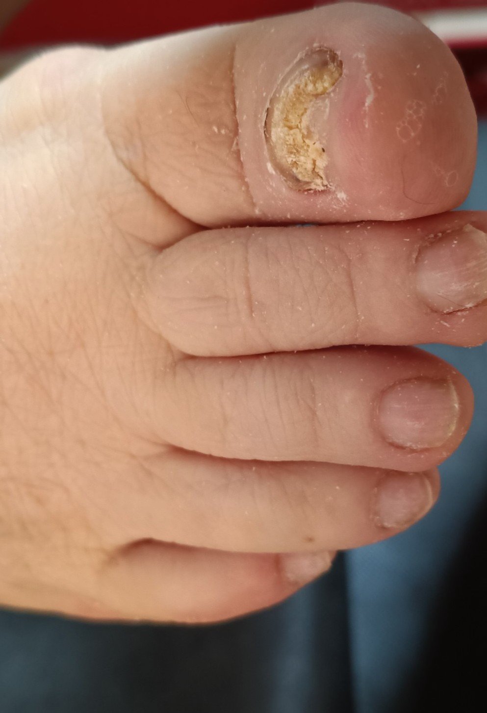 Tratamiento onicomicosis