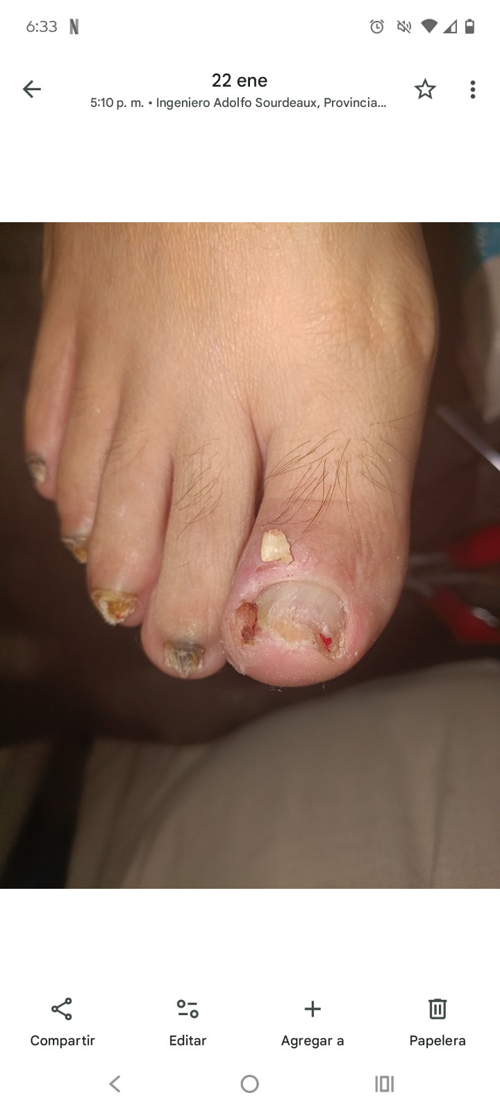 Onicocriptosis uña encarnada