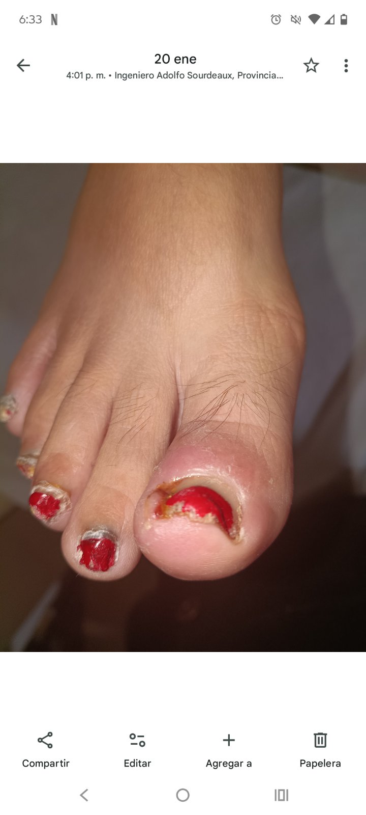 Onicocriptosis con infección